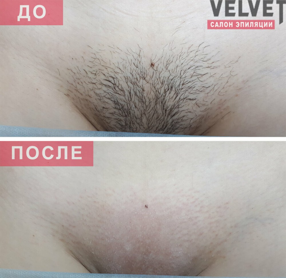 Эпиляция бикини глубокое
