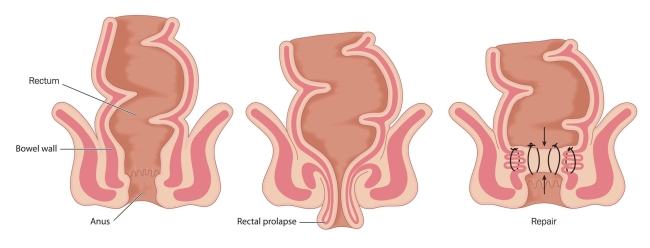 Rectum prolapse