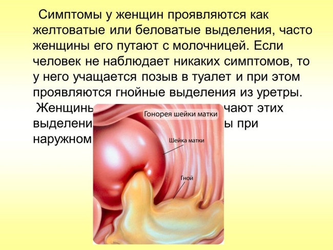 Симптомы гонореи у женщин