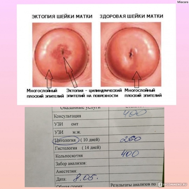 Эктопия цилиндрического эпителия шм