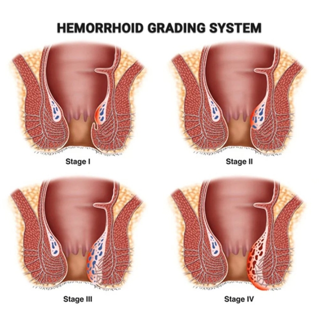 Internal hemorrhoids